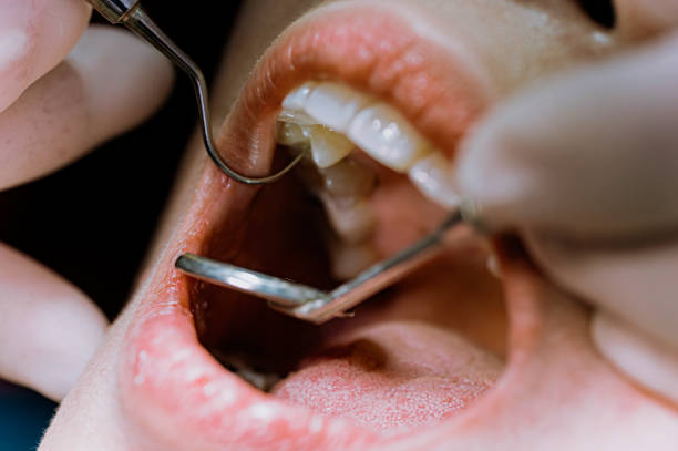عصب کشی دندان در خانه دهان فردی که باز است