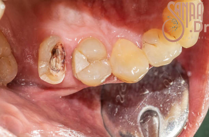 عفونت یکی از دندان های فرد