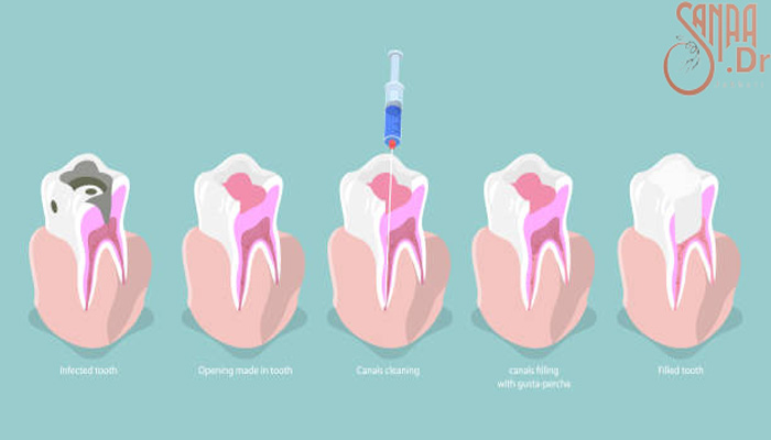 عکس سه بعدی که دارد درمان ریشه دندان را نشان میدهد.