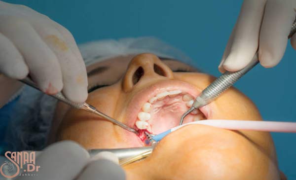 عفونت ریشه دندان عصب کشی شده - خانمی که دندانش را دارد درست می کند.