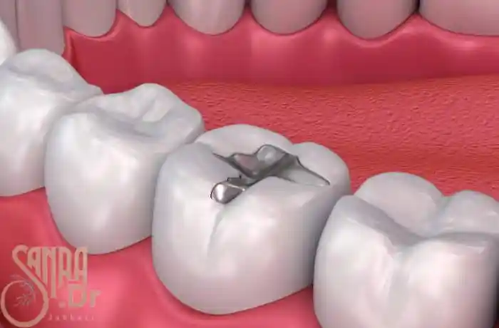 پر کردن دندان بعد از عصب کشی به صورت فلزی